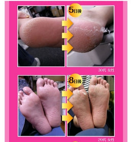 人気角質ケア商品　フットピーリングパック　ペロリン